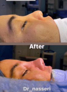 نمونه عمل بینی دکتر مسعود ناصری صدر