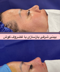 نمونه عمل بینی دکتر مسعود ناصری صدر