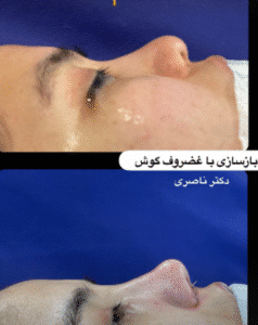 نمونه عمل بینی دکتر مسعود ناصری صدر