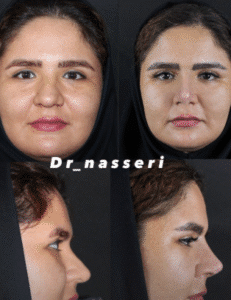 نمونه عمل بینی دکتر مسعود ناصری صدر