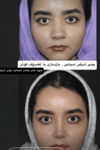 نمونه عمل بینی دکتر مسعود ناصری صدر