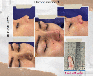 نمونه عمل بینی دکتر مسعود ناصری صدر