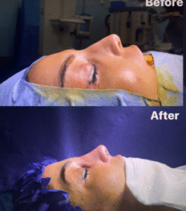 نمونه عمل بینی دکتر مسعود ناصری صدر