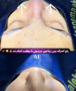 نمونه عمل بینی دکتر افسانه محمدپور مالکی