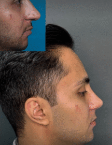 نمونه عمل بینی دکتر افسانه محمدپور مالکی