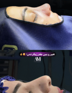 نمونه عمل بینی دکتر افسانه محمدپور مالکی