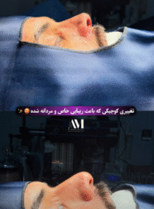 نمونه عمل بینی دکتر افسانه محمدپور مالکی