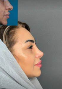 نمونه عمل بینی دکتر افسانه محمدپور مالکی