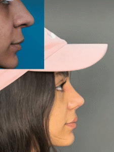 نمونه عمل بینی دکتر افسانه محمدپور مالکی