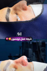 نمونه عمل بینی دکتر افسانه محمدپور مالکی