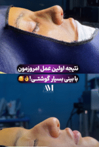 نمونه عمل بینی دکتر افسانه محمدپور مالکی