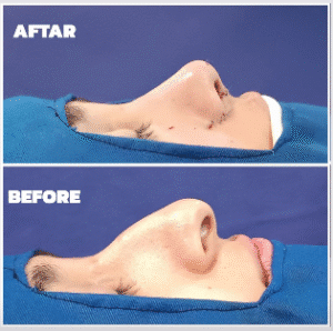 نمونه عمل بینی دکتر داریوش عرفانیان