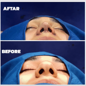 نمونه عمل بینی دکتر داریوش عرفانیان