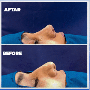 نمونه عمل بینی دکتر داریوش عرفانیان