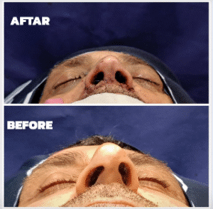 نمونه عمل بینی دکتر داریوش عرفانیان