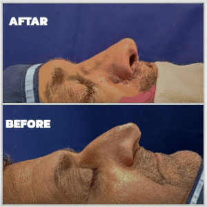 نمونه عمل بینی دکتر داریوش عرفانیان