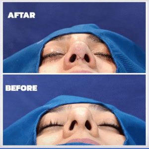 نمونه عمل بینی دکتر داریوش عرفانیان