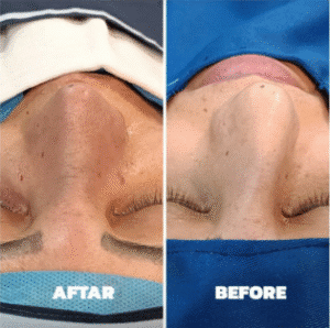 نمونه عمل بینی دکتر داریوش عرفانیان