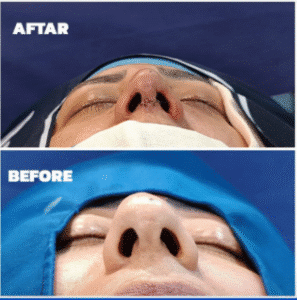 نمونه عمل بینی دکتر داریوش عرفانیان