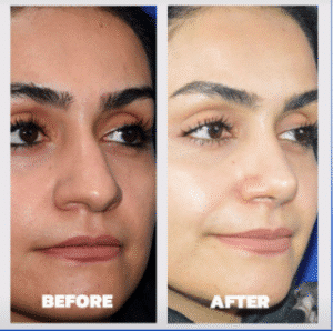 نمونه عمل بینی دکتر داریوش عرفانیان
