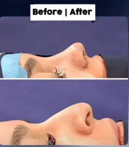 نمونه عمل بینی دکتر داریوش عرفانیان