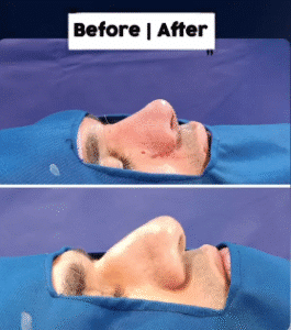 نمونه عمل بینی دکتر داریوش عرفانیان