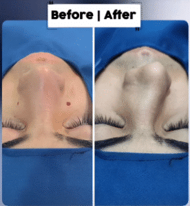 نمونه عمل بینی دکتر داریوش عرفانیان