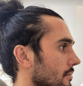 نمونه عمل بینی دکتر داریوش عرفانیان