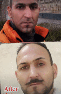 نمونه عمل بینی دکتر داریوش عرفانیان