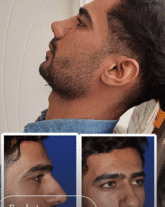 نمونه عمل بینی دکتر داریوش عرفانیان