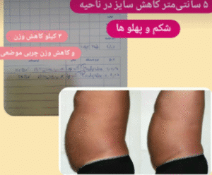 نمونه لاغری موضعی دپارتمان لاغری مانا