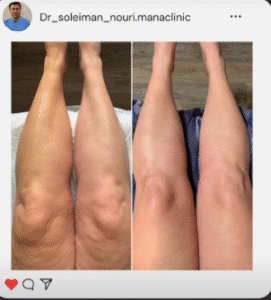 نمونه لاغری موضعی دپارتمان لاغری مانا