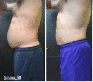 نمونه لاغری موضعی دپارتمان لاغری مانا