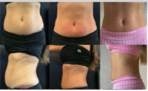 نمونه لاغری موضعی دپارتمان لاغری مانا