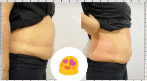 نمونه لاغری موضعی دپارتمان لاغری مانا