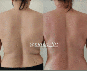 نمونه لاغری موضعی دپارتمان لاغری مانا