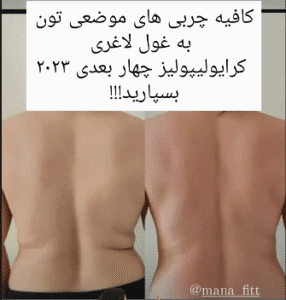 نمونه لاغری موضعی دپارتمان لاغری مانا