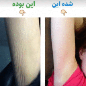 نمونه لاغری موضعی دپارتمان لاغری مانا