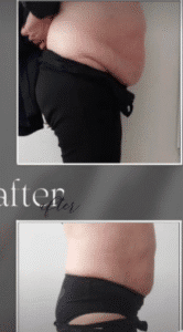 نمونه لاغری کلینیک زیبایی گلدن رویال