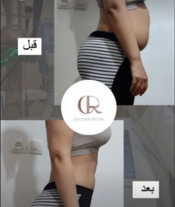 نمونه لاغری کلینیک زیبایی گلدن رویال