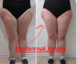 نمونه لاغری کلینیک زیبایی گلدن رویال