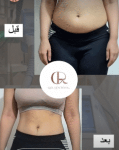 نمونه لاغری کلینیک زیبایی گلدن رویال
