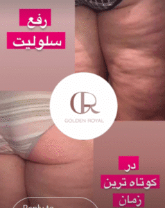 نمونه لاغری کلینیک زیبایی گلدن رویال