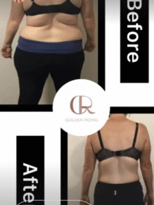 نمونه لاغری کلینیک زیبایی گلدن رویال