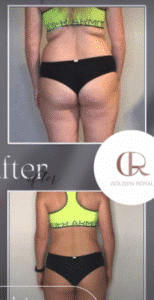 نمونه لاغری کلینیک زیبایی گلدن رویال