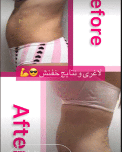 نمونه لاغری کلینیک زیبایی گلدن رویال