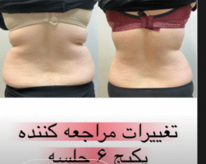 نمونه لاغری کلینیک زیبایی گلدن رویال