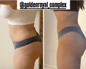 نمونه لاغری کلینیک زیبایی گلدن رویال