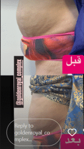 نمونه لاغری کلینیک زیبایی گلدن رویال
