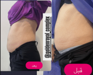نمونه لاغری کلینیک زیبایی گلدن رویال